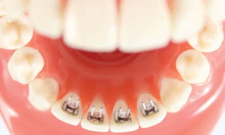 Action 德赢vwinac登录Orthodontics介绍舌头训练师