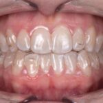SureSmile Aligners和Class I与适度Class III模式